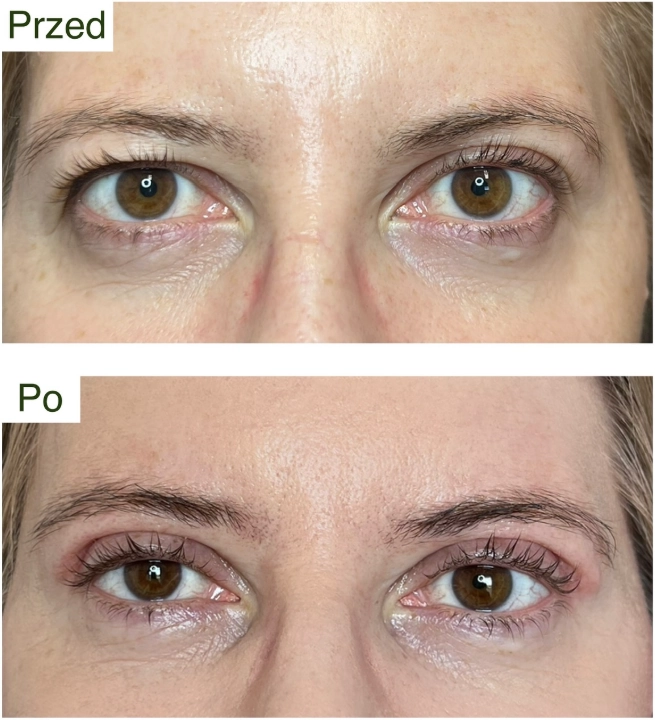 blefaroplastyka 