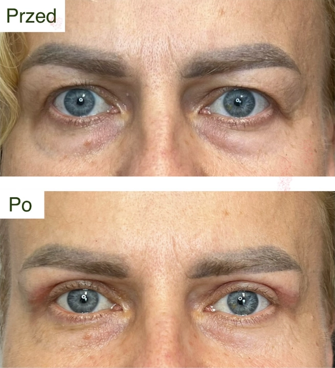 blefaroplastyka 
