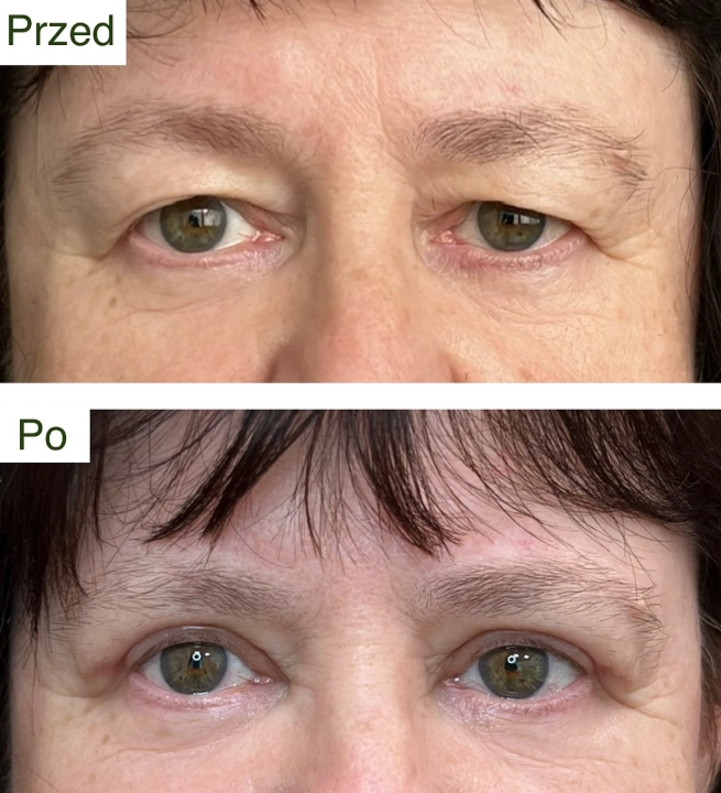 blefaroplastyka 