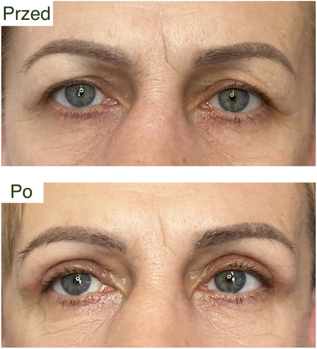 blefaroplastyka 