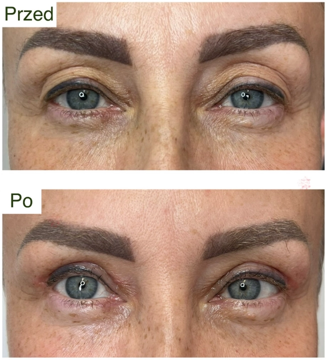 blefaroplastyka 