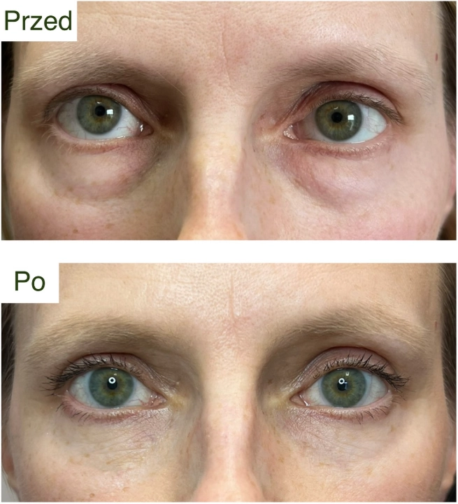 blefaroplastyka 
