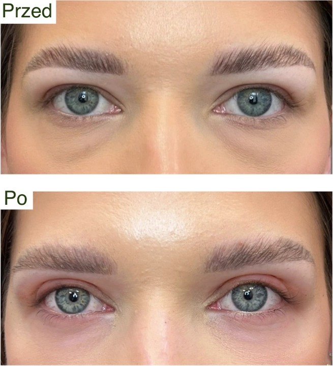 blefaroplastyka 