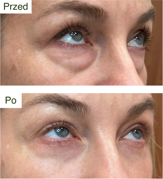 blefaroplastyka 