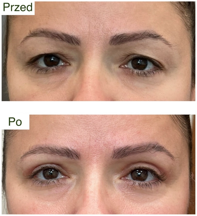 blefaroplastyka 