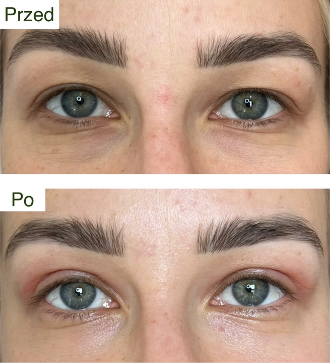 blefaroplastyka 