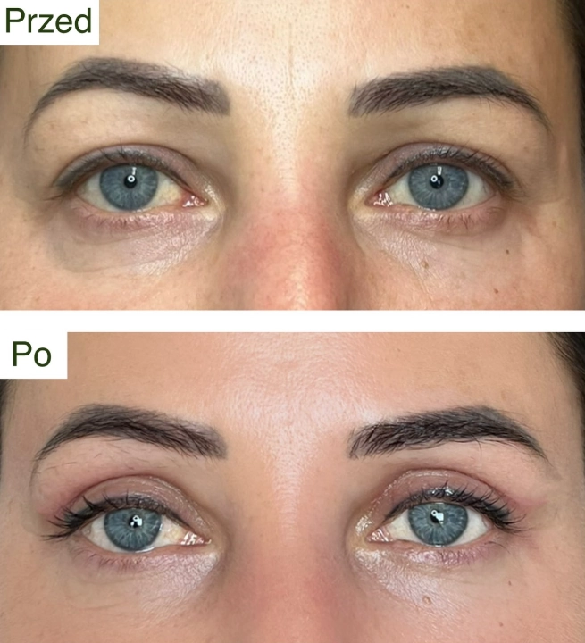 blefaroplastyka 