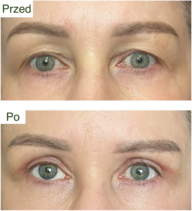 blefaroplastyka 