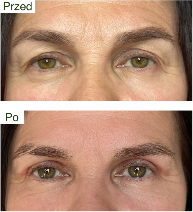 blefaroplastyka 