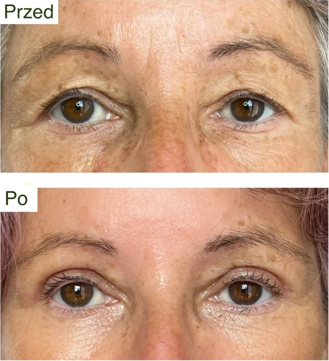 blefaroplastyka 