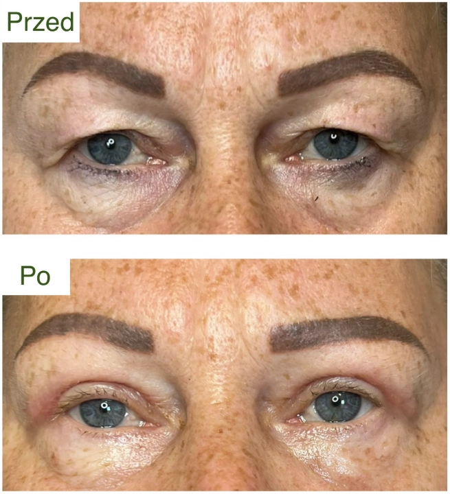 blefaroplastyka 