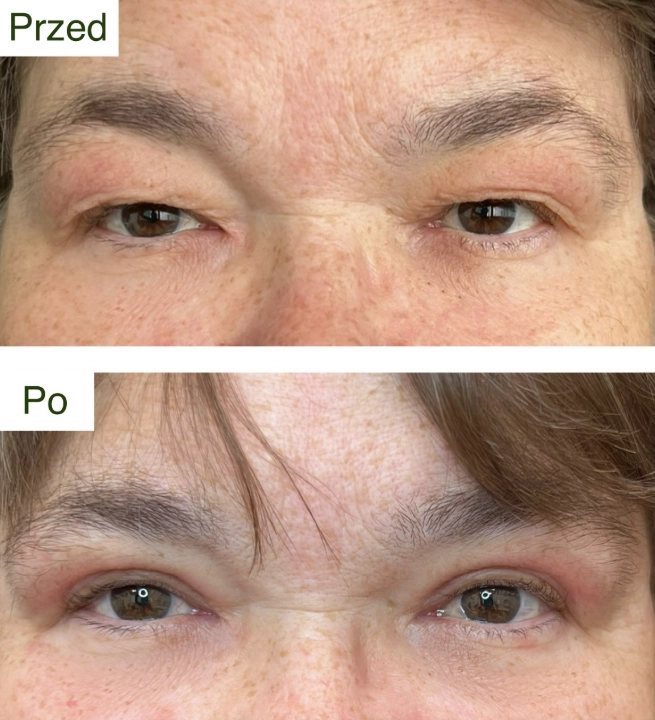 blefaroplastyka 