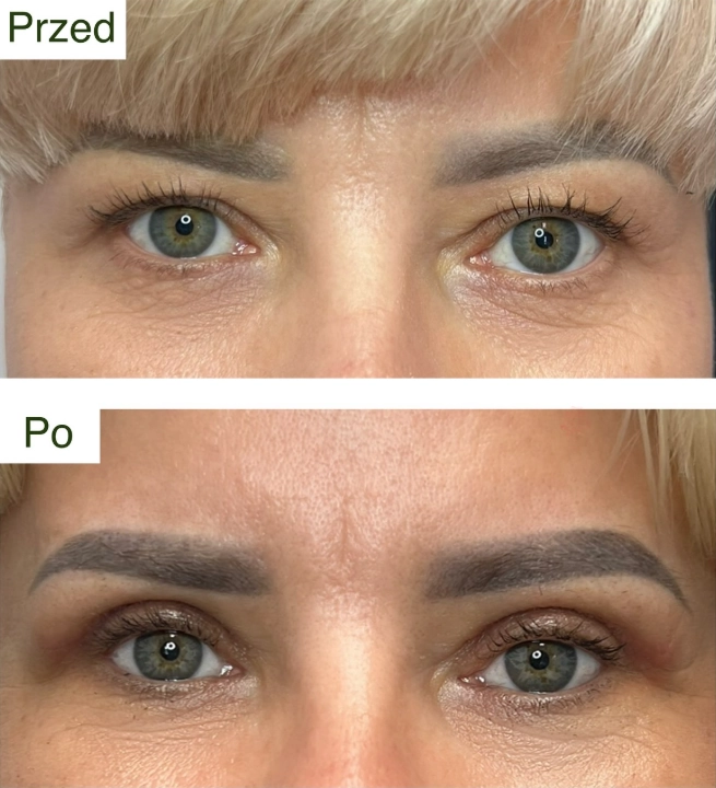 blefaroplastyka 