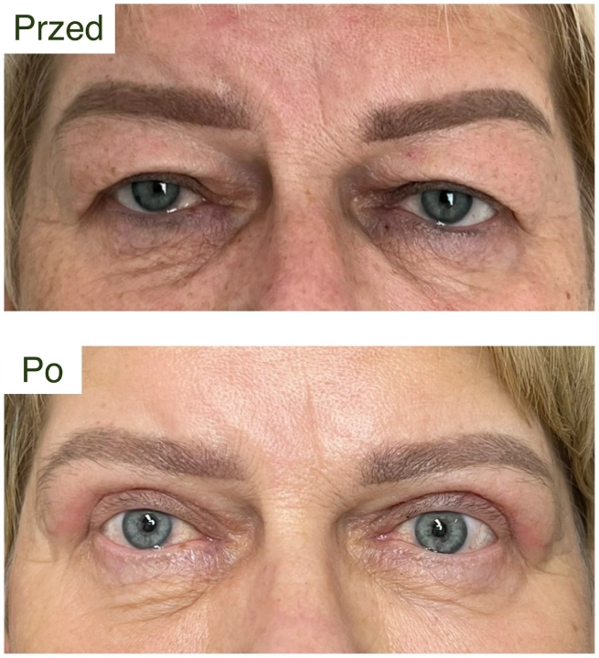 plastyka powiek