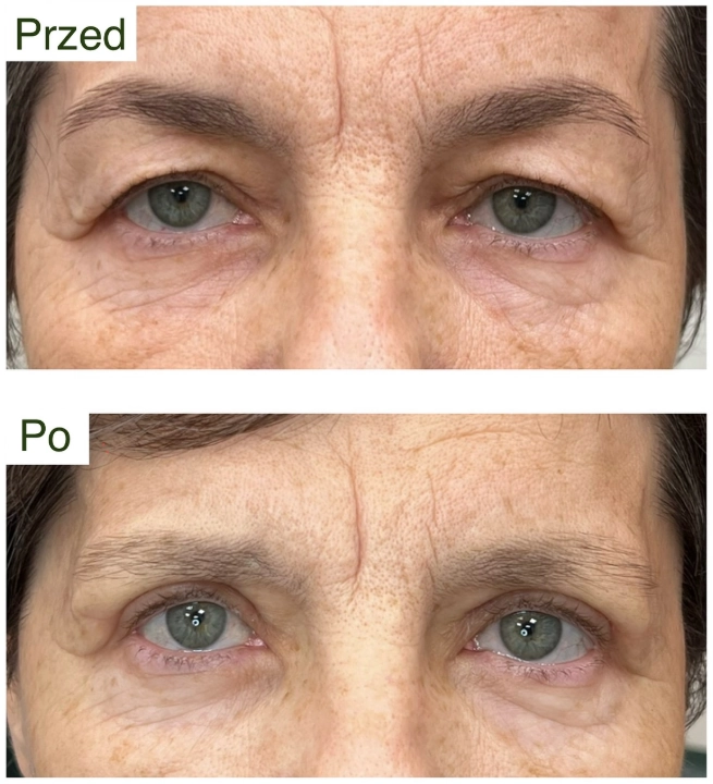 plastyka powiek